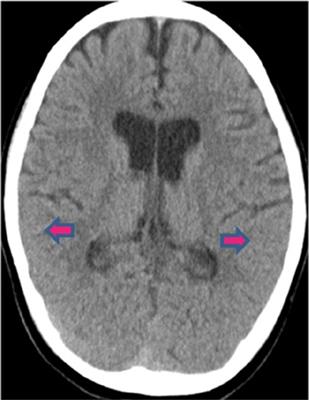 Case report: Presentations and cytokine profiles of inflammatory non-pulmonary COVID-19 and related diseases in children